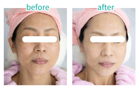 美白パックコース＋セラミド導入